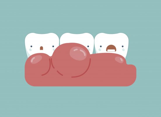Gingivitis around the teeth ,dental concept